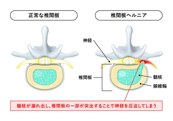 腰椎椎間板ヘルニア