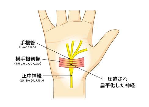 手根管症候群（しゅこんかんしょうこうぐん）