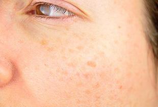 メラニンとは？しみができる仕組みや色素沈着を緩和する方法について解説