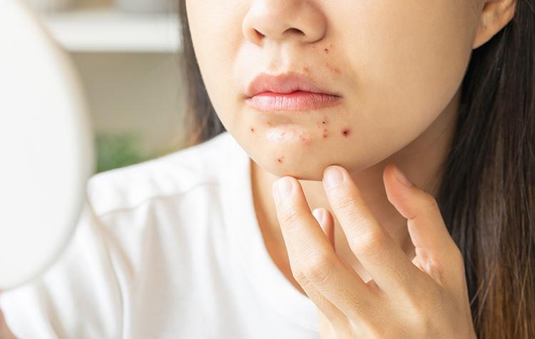 あご(顎)ニキビの原因と対策を紹介！ 繰り返すニキビはしっかりケアしよう