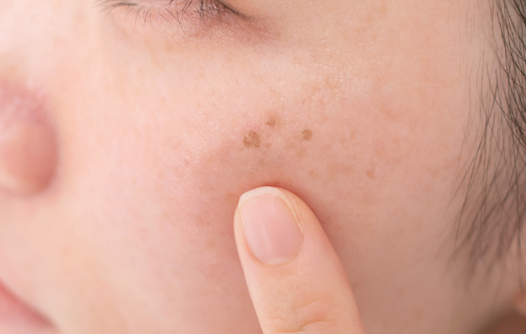 サイバー ドラゴン パチスロ沈着とは？しみや黒ずみ、くすみには体の内側と外側から対策しよう！