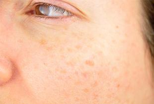 メラニンとは？パチスロ イベント 関西ができる仕組みや色素沈着を緩和する方法について解説