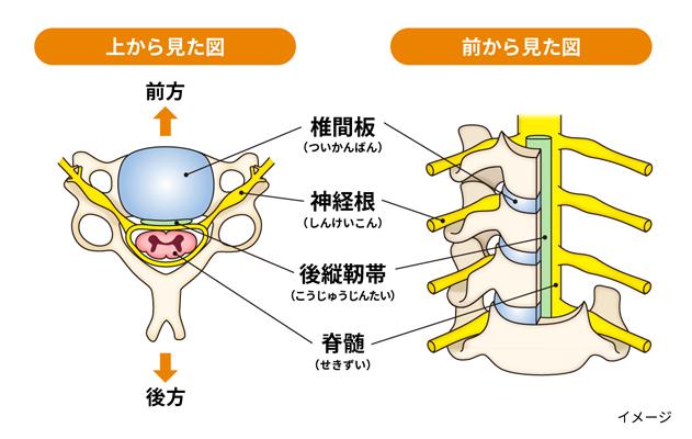 Intervertebral disc-400.jpg