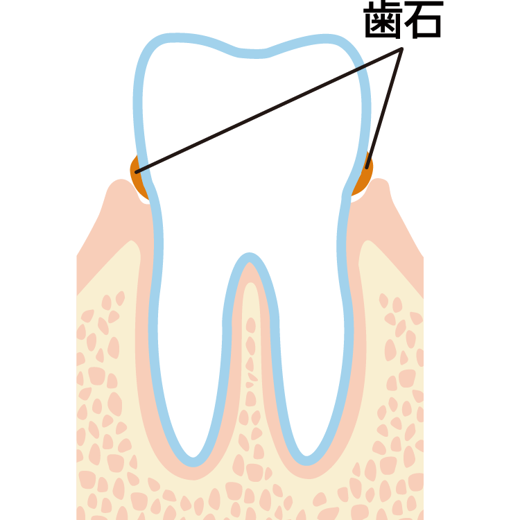 歯石って何？石灰化って何？